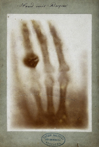 first X-ray