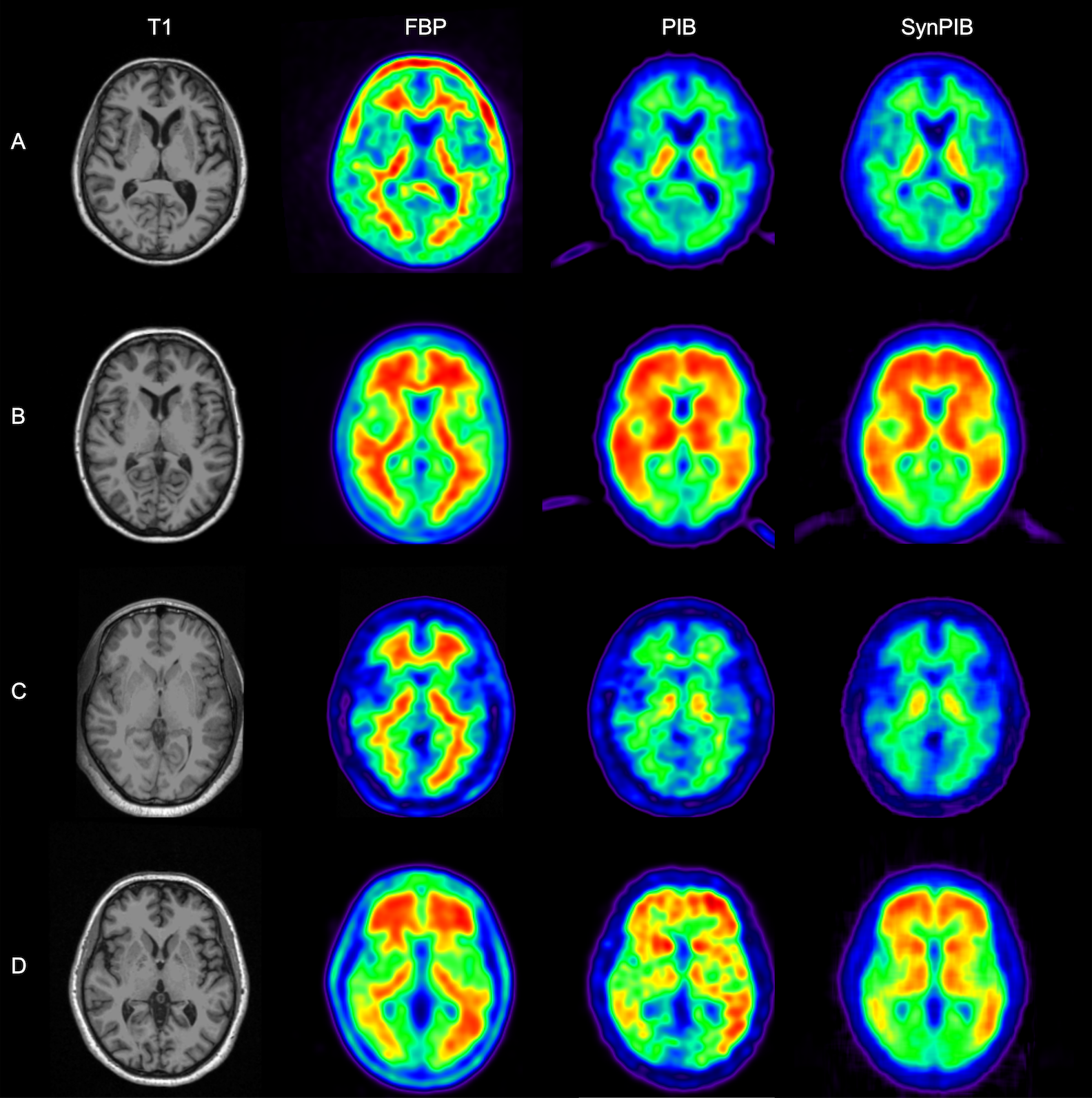 positron emission tomography images of human brains 