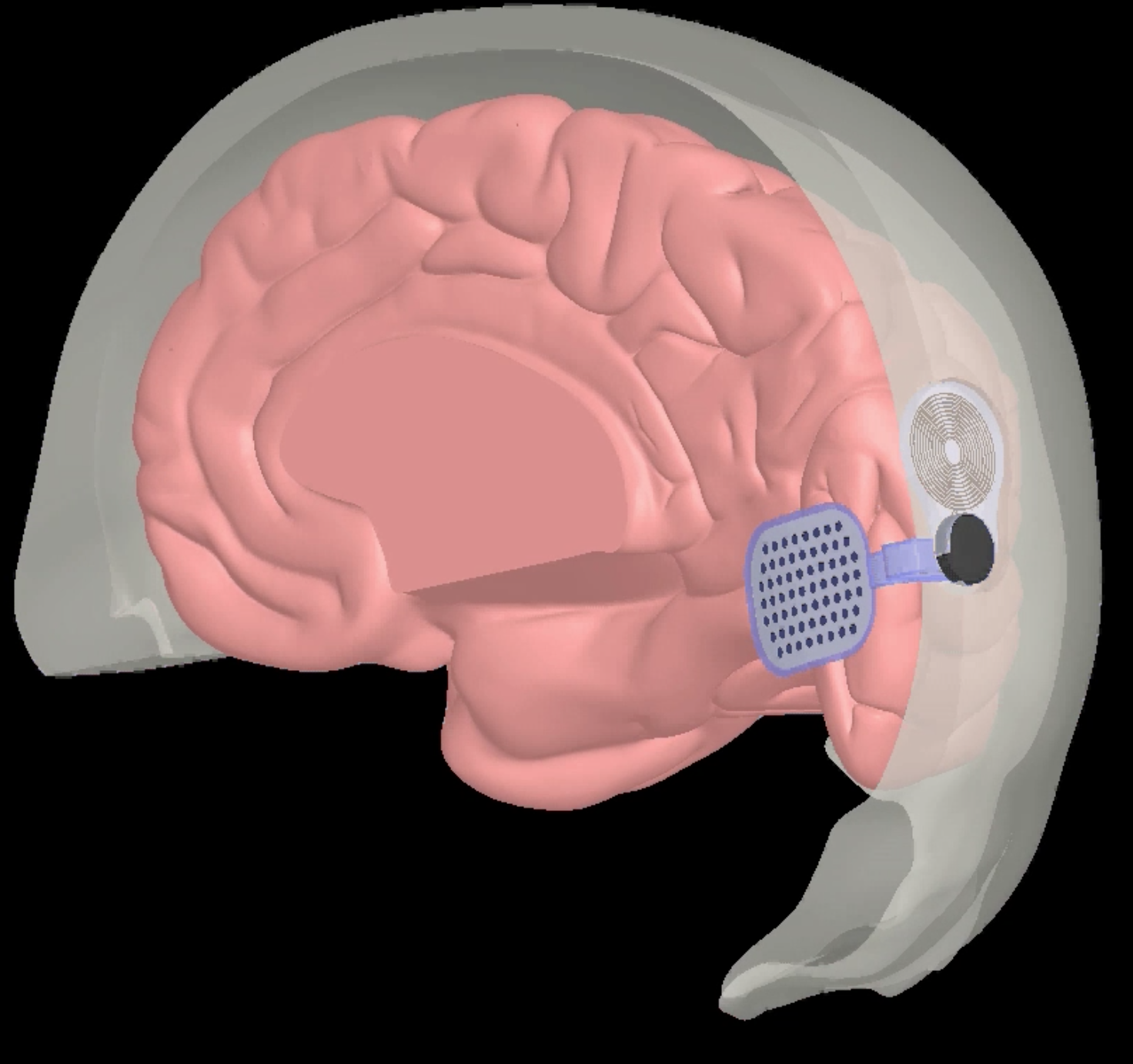 Animation of a bionic eye implant and the brain