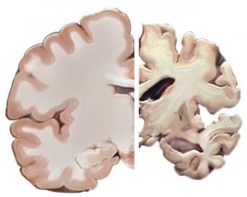 Alzheimer's brain healthy brain