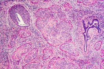 Microscope closeup of cervical cancer