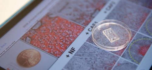 A microfluidic chip created by a team of Arizona State University researchers sits on top of images of cancer cells and fibroblast cells.