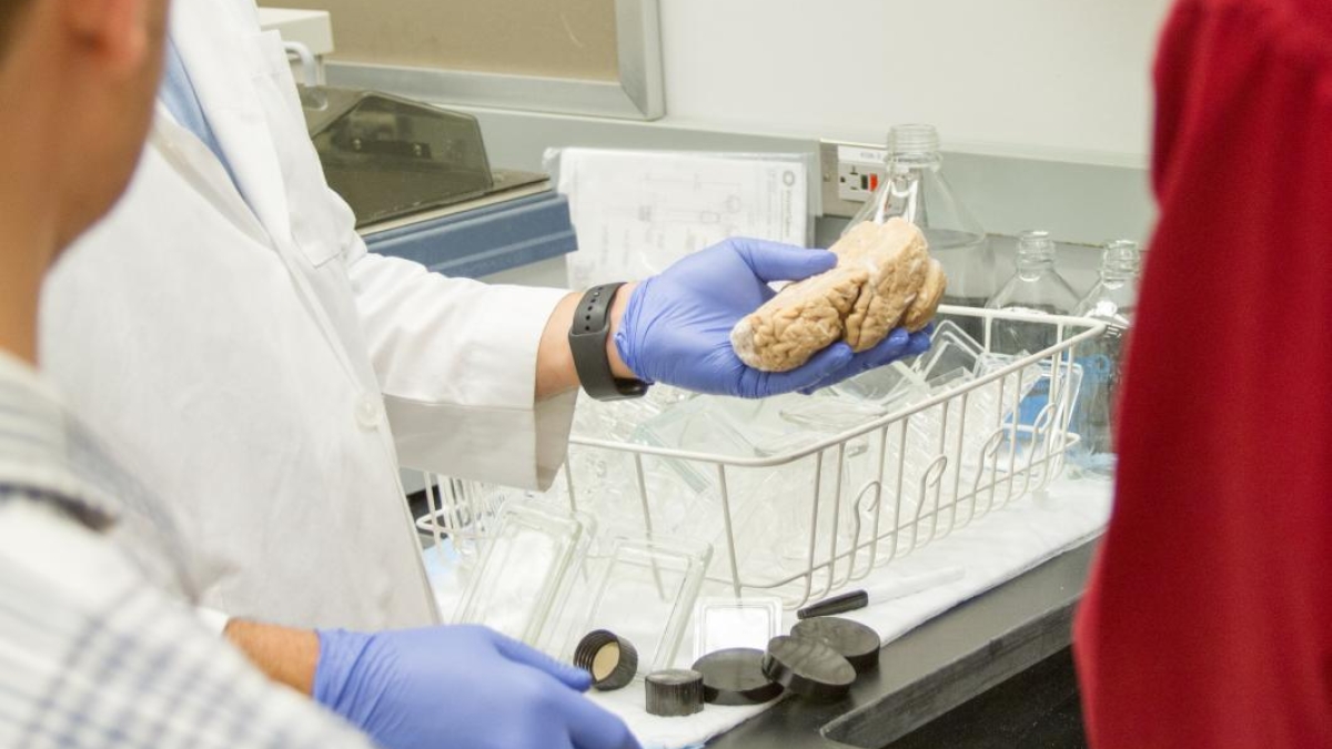 Scientist holds part of a human brain affected by Alzheimer's.