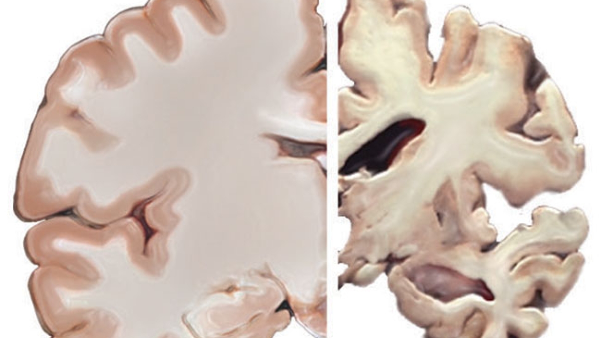 Alzheimer&#039;s brain healthy brain