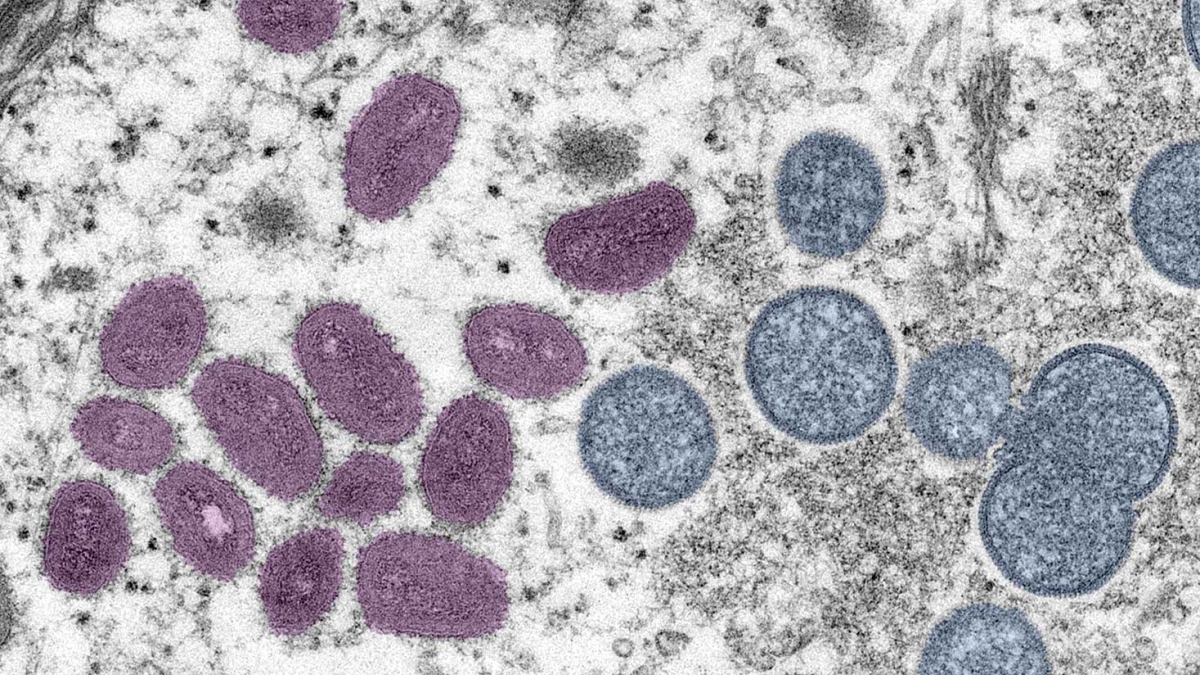 monkeypox virus particles undermicroscope