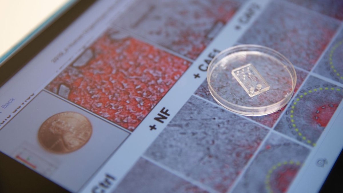 A microfluidic chip created by a team of Arizona State University researchers sits on top of images of cancer cells and fibroblast cells.