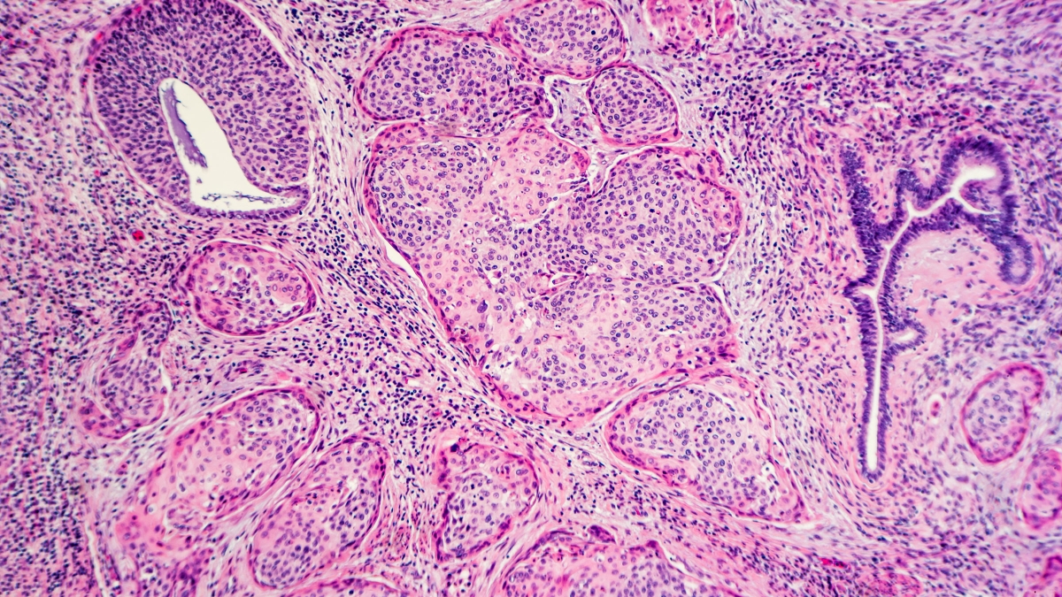 Microscope closeup of cervical cancer