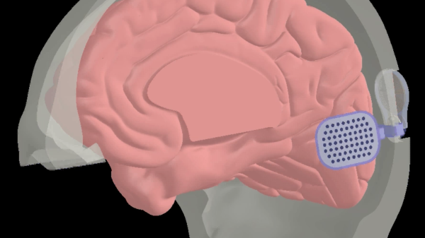 Illustration of a brain implant