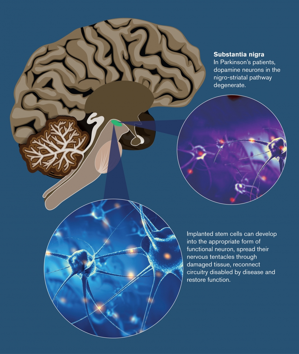 Graphic shows the implanting of stem cells in a region of the brain known as the substantia nigra